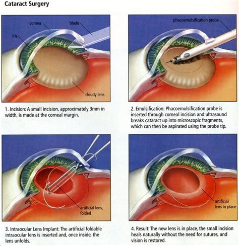 Cataract – The Bio Log