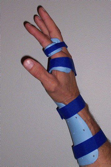 Extensor Tendon Injuries - Dr. Groh