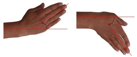 14: Range of Wrist Motion: Radial-Ulnar Deviation. Wrist joint motion... | Download Scientific ...