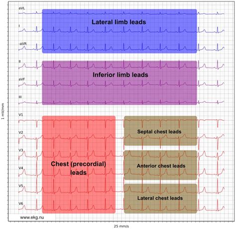 Ecg Interpretation Ecg Blog 175 Lead Reversal Lateral - vrogue.co