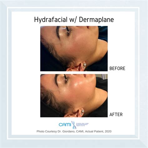 HydraFacial vs Microdermabrasion: Which One Is Right For You? | CAMI