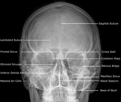 Dentistry lectures for MFDS/MJDF/NBDE/ORE: Radiographic Anatomy of Facial Bones and Mandible ...