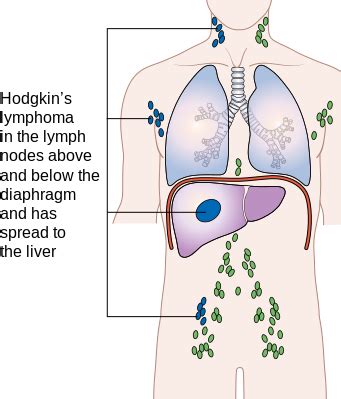 Hodgkin's lymphoma staging - wikidoc