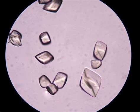 High Serum Uric Acid Level Independently Predicts Non-Calcified Plaques - The Cardiology Advisor