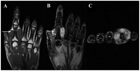 Giant Cell Tumor Of Tendon Sheath Mri | Hot Sex Picture