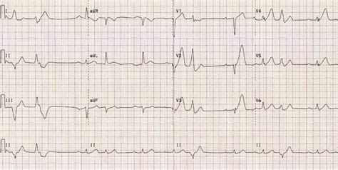 Acute Anterior Stemi Ekg