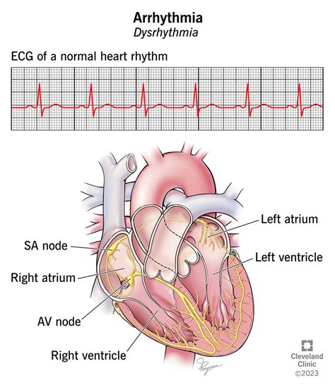 Understanding Arrhythmia: Causes And Treatments - Ask The Nurse Expert