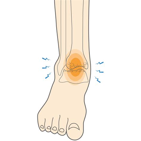 What is Ankle Arthritis & What Symptoms Should You Watch For? - Upswing ...