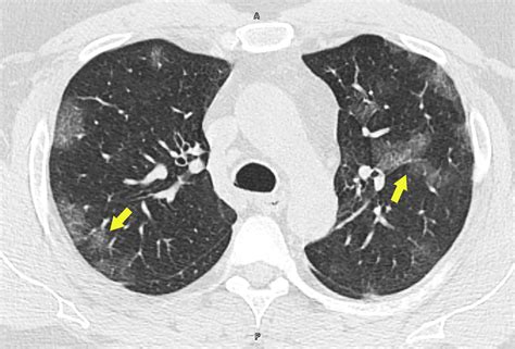 Cureus | A Coronavirus Disease 2019 (COVID-19) Patient with Multifocal Pneumonia Treated with ...