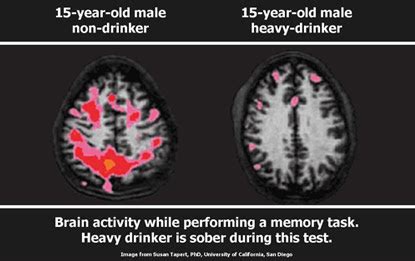 Download What Part Of The Brain Is Affected By Alcohol First Pictures ...