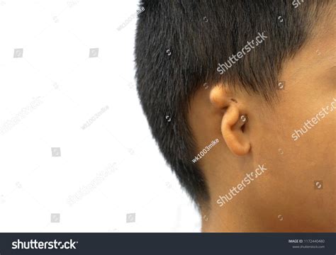 Microtia Congenital Deformity Where Pinna External Stock Photo ...