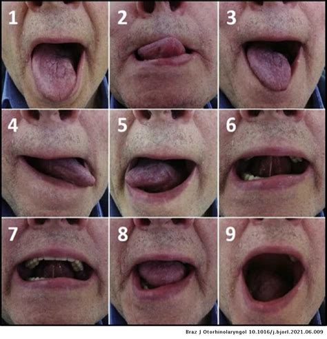 Long-term functional outcomes and quality of life after partial glossectomy for T2 squamous cell ...