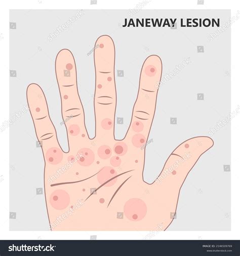 18 Janeway Lesions Images, Stock Photos & Vectors | Shutterstock