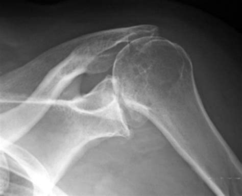 Posterior Shoulder Dislocation - Orthopedics - Medbullets Step 2/3