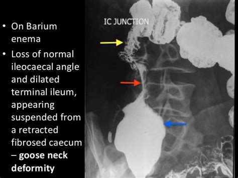 intetinal tuberculosis