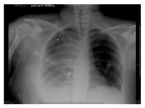 Hemo Pneumothorax X Ray