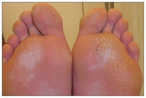 Pitted keratolysis: an infective cause of foot odour | CMAJ