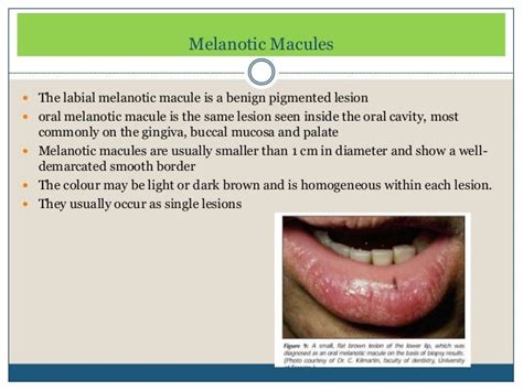 Pigmented lesions of oral cavity