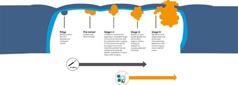 CAR-T Cell Immunotherapy & Stem Cells for Colorectal Cancer