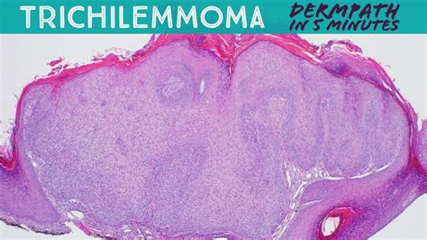 Trichilemmoma (mimic of wart): Dermpath in 5 Minutes (dermatology pathology dermatopathology ...