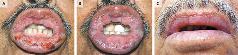 Pyostomatitis Vegetans | NEJM