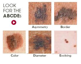 Symptoms - Midwest Dermatology : Midwest Dermatology