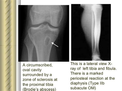 107 best OSTEOMYELITIS images on Pinterest | Radiology, Bones and Dice