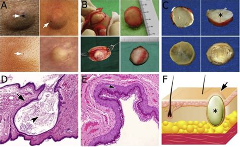 Overview of epidermoid cyst - European Journal of Radiology Open