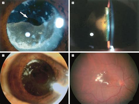 Morgagnian Cataract With an Isolated Posterior Capsular Opening | Cataract and Other Lens ...