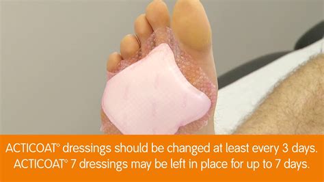 Acticoat dressing application on Diabetic Foot Ulcer - YouTube