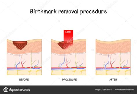 Birthmark Laser Removal Treatment Procedure Stock Vector by ©edesignua ...