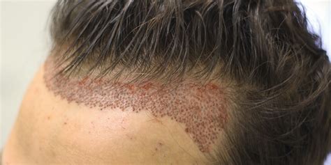 Hair Transplant Cost USA | Asli Tarcan Clinic