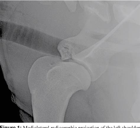 ARTHROSCOPIC TREATMENT OF AN INCOMPLETE AVULSION FRACTURE OF THE SUPRAGLENOID TUBEROSITY IN A ...