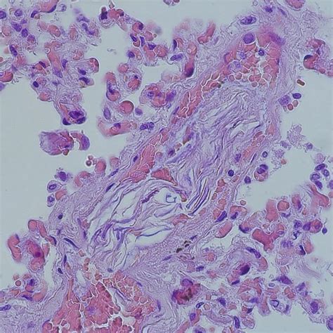 Anatomy and forensic pathology on Instagram: “Amniotic Fluid Embolism ...