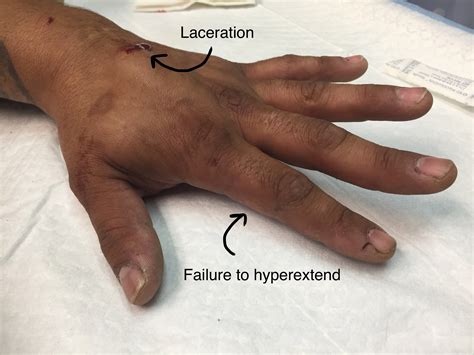 Extensor Tendon Injuries, Part II – Closing the Gap