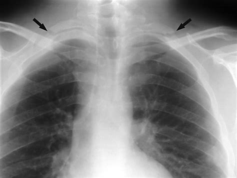 Bilateral first rib fractures due to tardive dystonia | Journal of Neurology, Neurosurgery ...