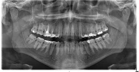 Orthopantomogram | News | Dentagama