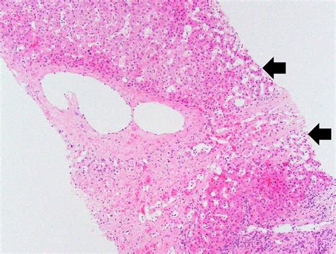 Pathology Outlines - Cardiac (congestive) hepatopathy and Fontan associated liver disease