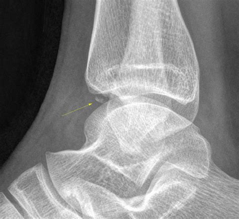 Distal Tibia Fracture