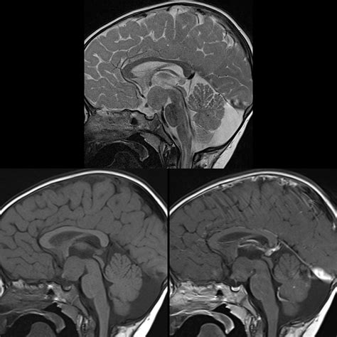 Pediatric Hamartoma of the Tuber Cinereum | Pediatric Radiology ...