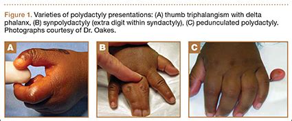 Polydactyly of the Hand | MDedge Surgery