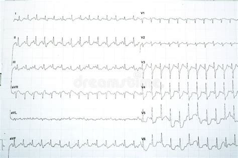 Electrocardiogram Test Results for Myocardial Ischemia Diagnosis Stock Image - Image of ...