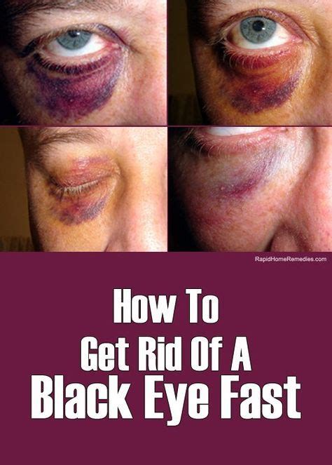 14 Simple Ways to Get Rid of Black Eye | Home health remedies, Health and wellbeing, Health and ...