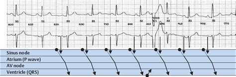 Ventricular Extrasystole | Thoracic Key