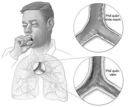 Bronchitis spasm - cause, symptoms and treatment