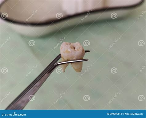 Extracted Molar Tooth in Tweezers Against the Background of the Dental Tray Stock Photo - Image ...