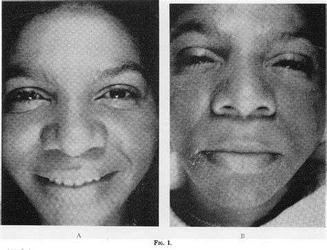 Figure 1 from Pyridoxine deficiency in human beings induced with desoxypyridoxine. | Semantic ...