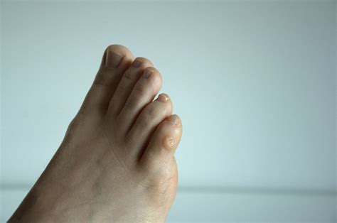 What’s the Difference Between Foot Corns vs Foot Calluses? - Foot and ...