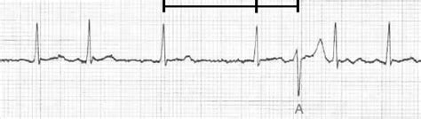 Ashman Phenomenon • LITFL • Medical Eponym Library