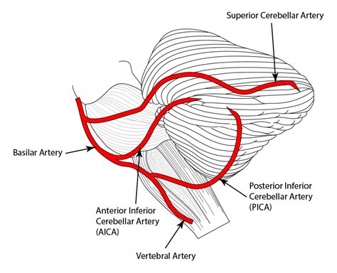 Posterior inferior cerebellar artery infarct - donreference